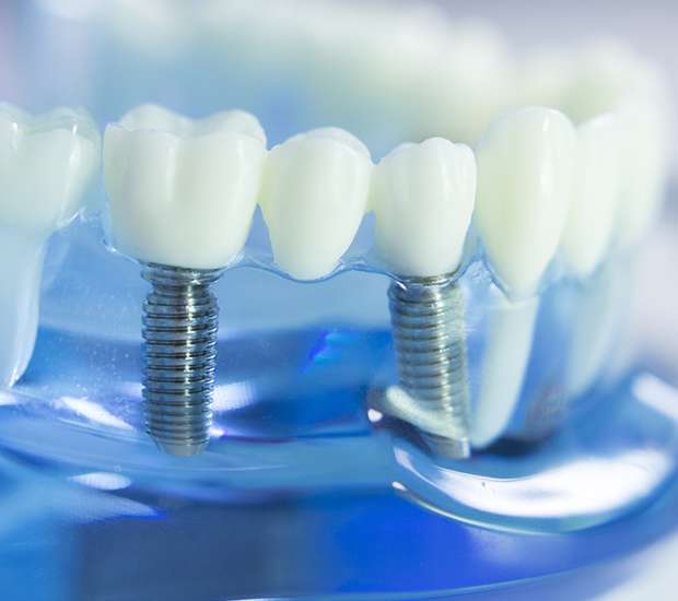 Chattanooga Dental Implants